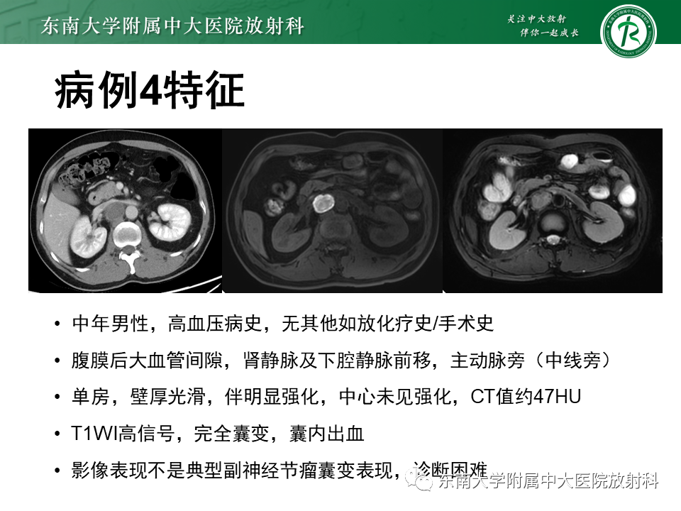 影像PPT - 【PPT】原发性腹膜后囊性病变-57