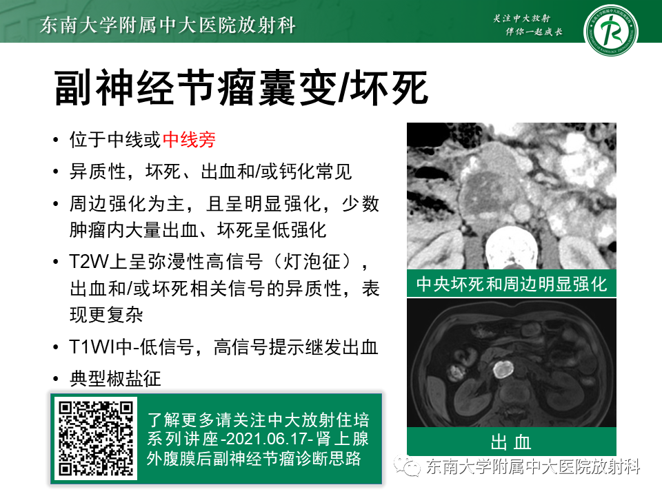 影像PPT - 【PPT】原发性腹膜后囊性病变-60