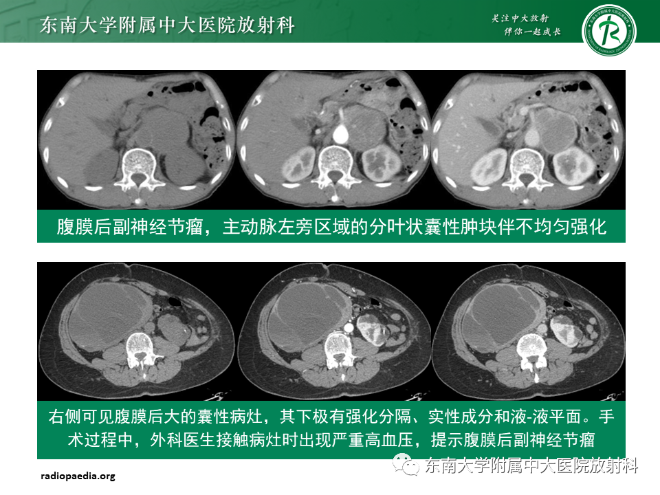 影像PPT - 【PPT】原发性腹膜后囊性病变-61