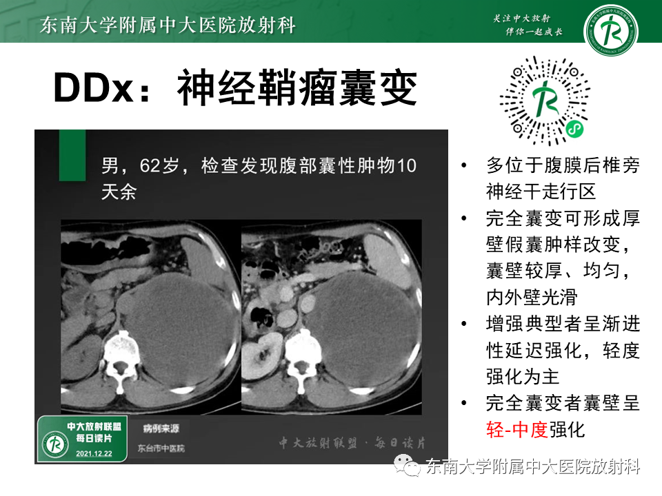 影像PPT - 【PPT】原发性腹膜后囊性病变-62