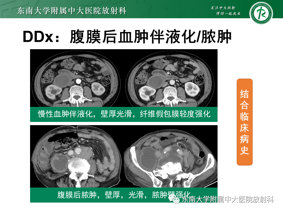 影像PPT - 【PPT】原发性腹膜后囊性病变-64