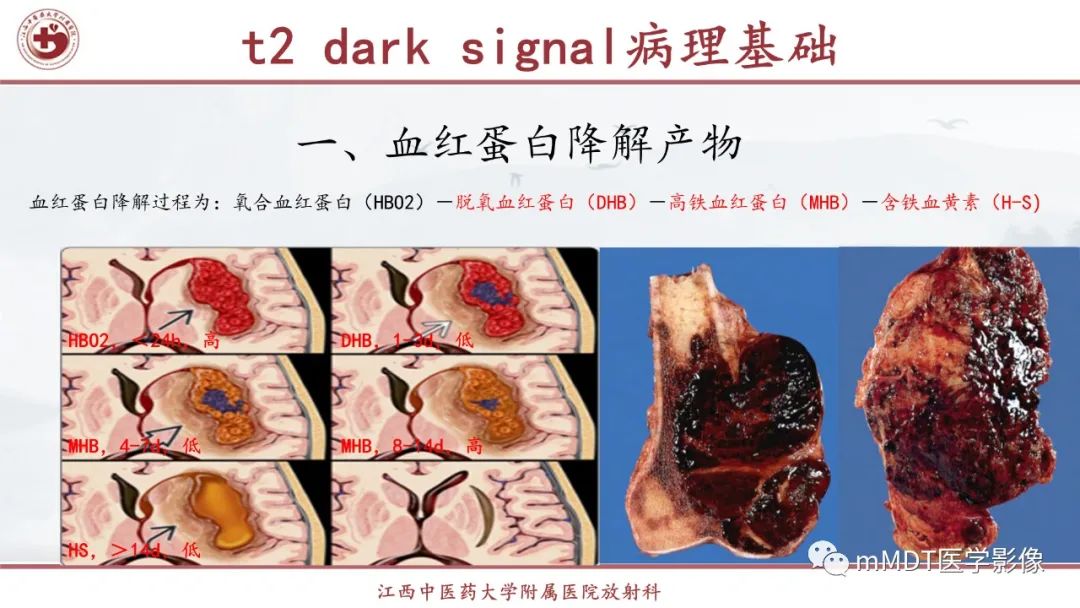 影像PPT - 【PPT】超短T2信号为主的局限性骨肌病变-2