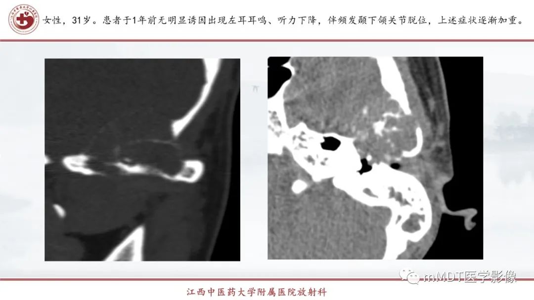 影像PPT - 【PPT】超短T2信号为主的局限性骨肌病变-9
