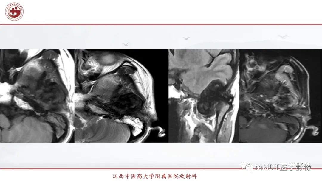 影像PPT - 【PPT】超短T2信号为主的局限性骨肌病变-10