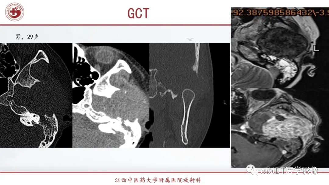 影像PPT - 【PPT】超短T2信号为主的局限性骨肌病变-12
