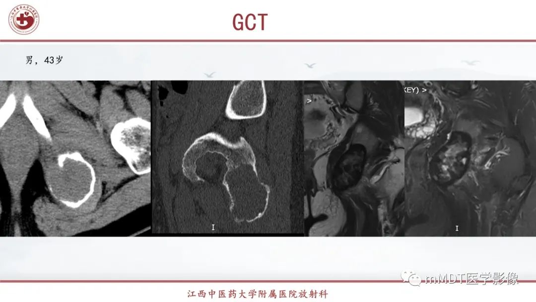 影像PPT - 【PPT】超短T2信号为主的局限性骨肌病变-13