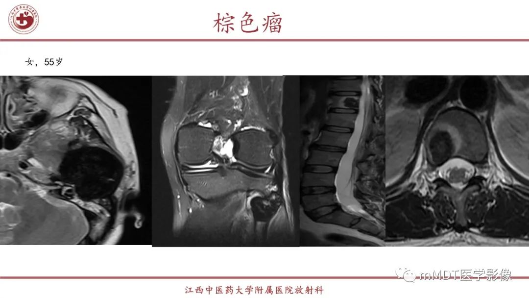 影像PPT - 【PPT】超短T2信号为主的局限性骨肌病变-14