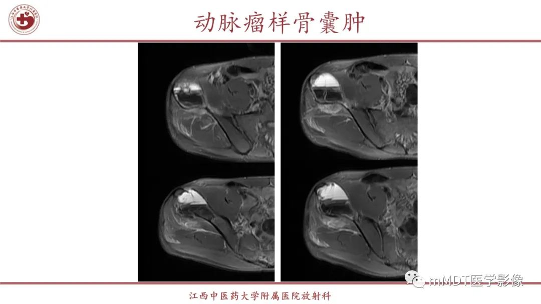 影像PPT - 【PPT】超短T2信号为主的局限性骨肌病变-15