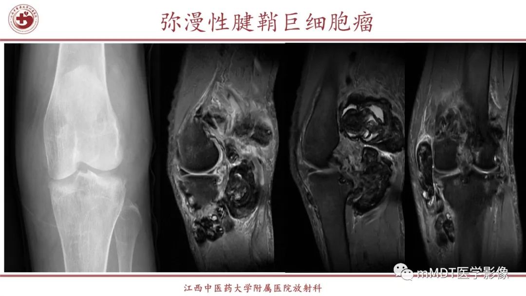 影像PPT - 【PPT】超短T2信号为主的局限性骨肌病变-16