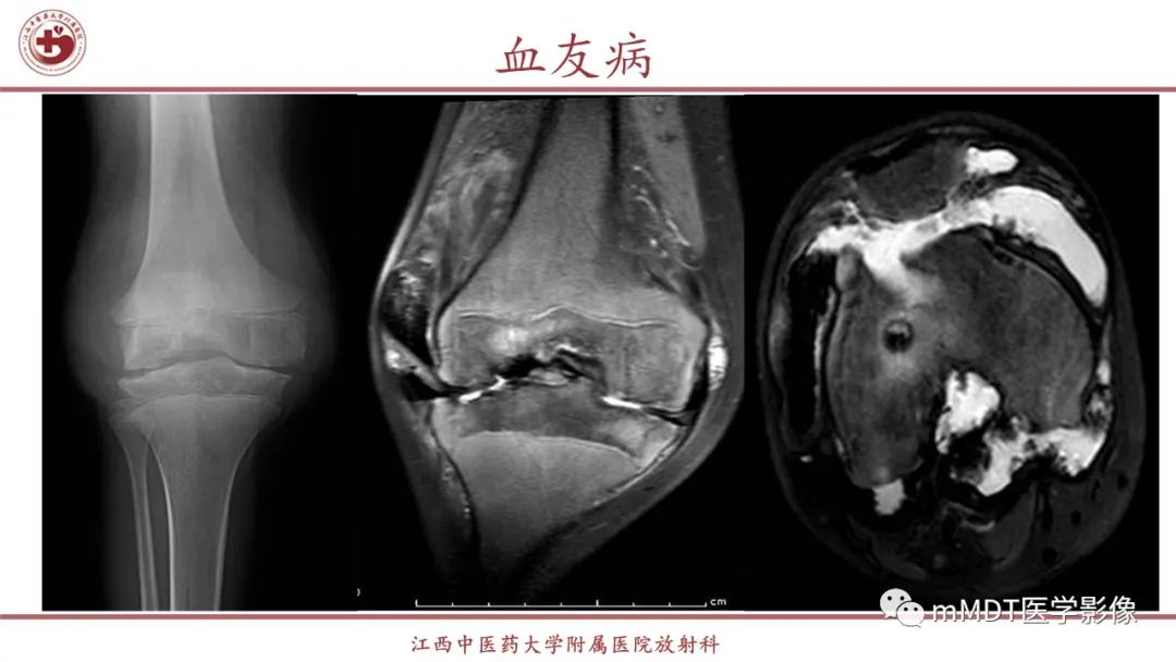 影像PPT - 【PPT】超短T2信号为主的局限性骨肌病变-18