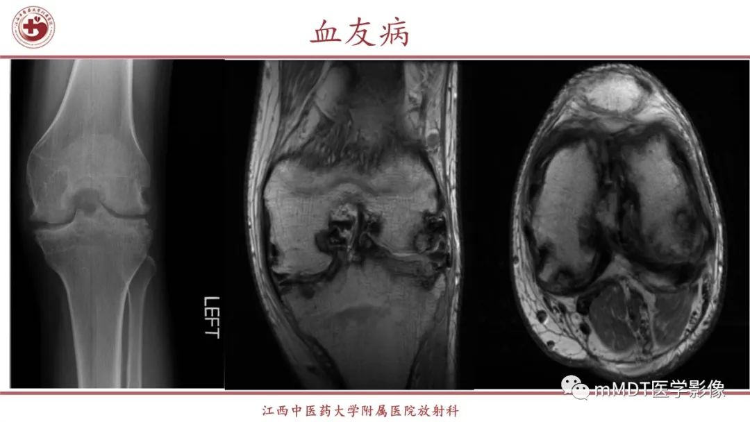 影像PPT - 【PPT】超短T2信号为主的局限性骨肌病变-17