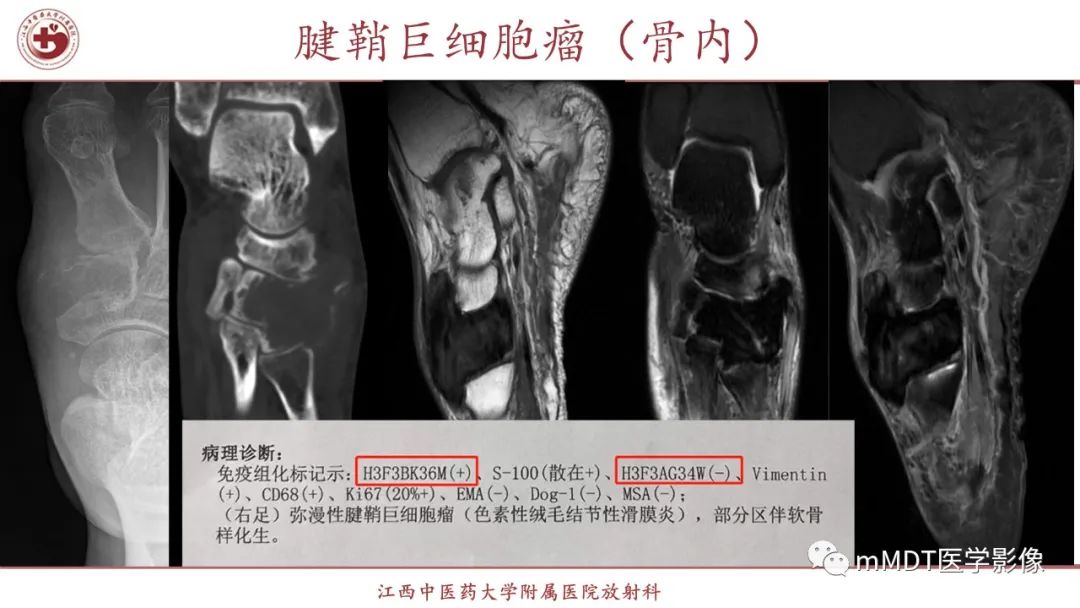 影像PPT - 【PPT】超短T2信号为主的局限性骨肌病变-20
