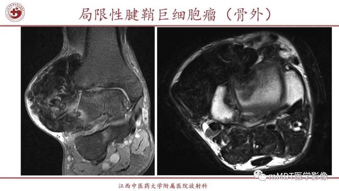 影像PPT - 【PPT】超短T2信号为主的局限性骨肌病变-19
