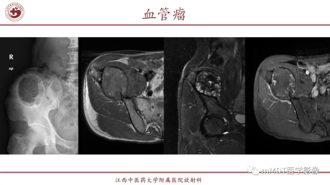 影像PPT - 【PPT】超短T2信号为主的局限性骨肌病变-22