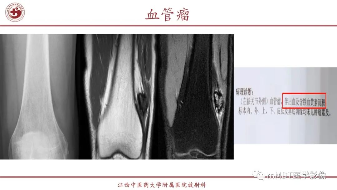 影像PPT - 【PPT】超短T2信号为主的局限性骨肌病变-23