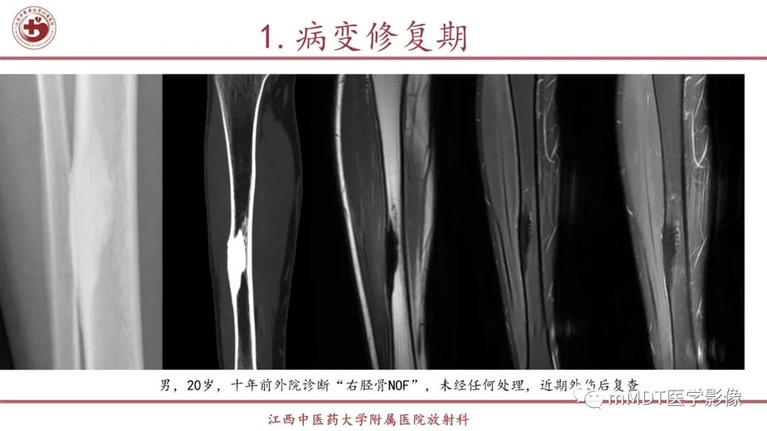 影像PPT - 【PPT】超短T2信号为主的局限性骨肌病变-25