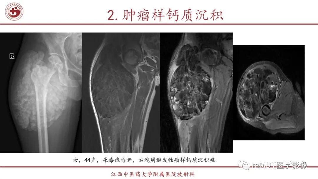 影像PPT - 【PPT】超短T2信号为主的局限性骨肌病变-27