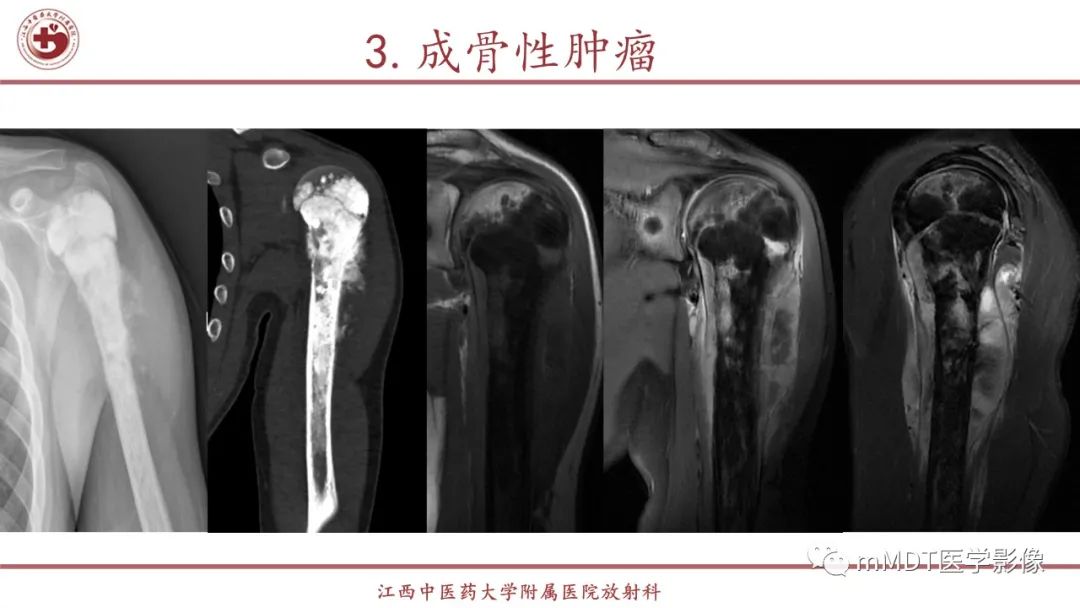 影像PPT - 【PPT】超短T2信号为主的局限性骨肌病变-28