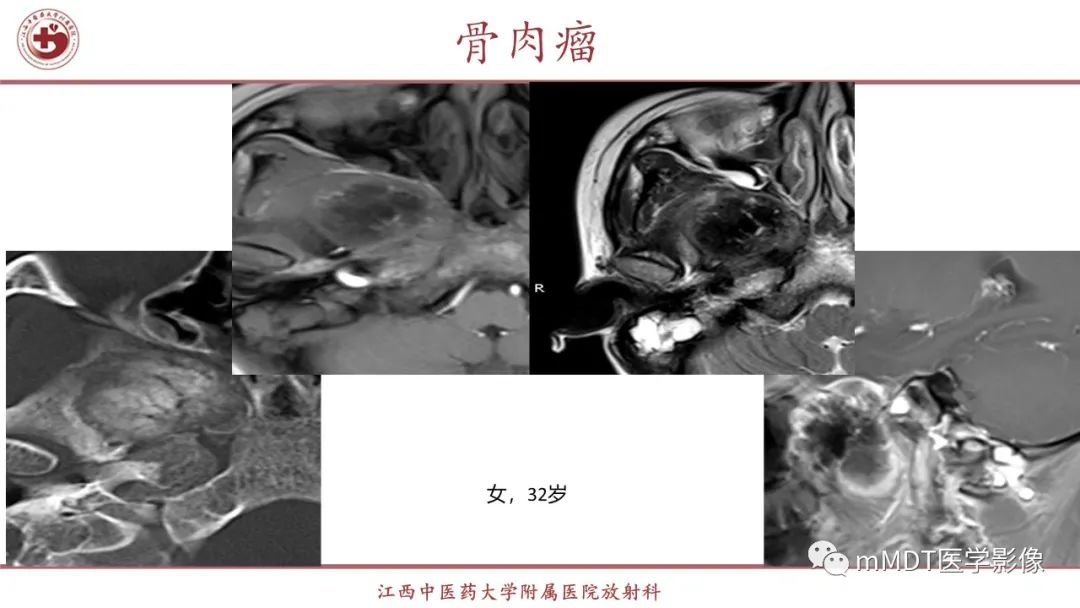 影像PPT - 【PPT】超短T2信号为主的局限性骨肌病变-29