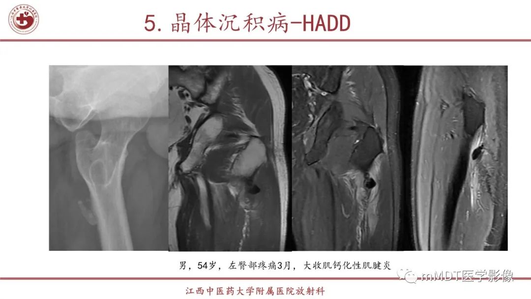 影像PPT - 【PPT】超短T2信号为主的局限性骨肌病变-31
