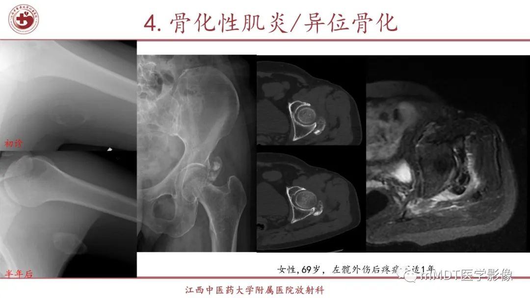 影像PPT - 【PPT】超短T2信号为主的局限性骨肌病变-30