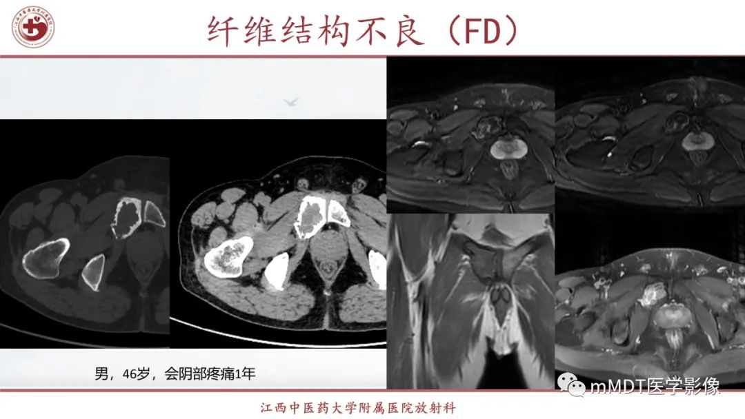 影像PPT - 【PPT】超短T2信号为主的局限性骨肌病变-35