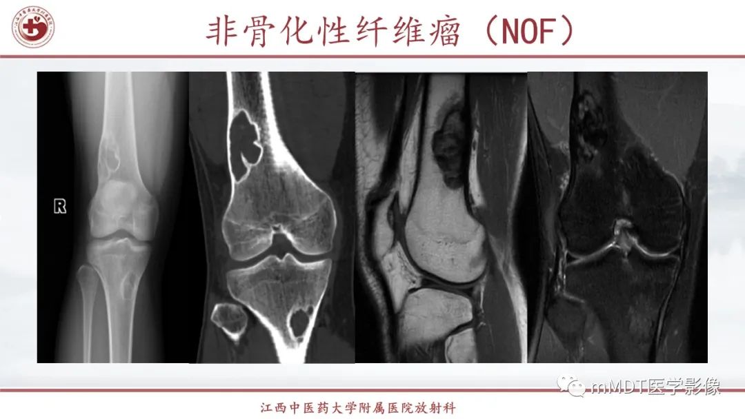 影像PPT - 【PPT】超短T2信号为主的局限性骨肌病变-36