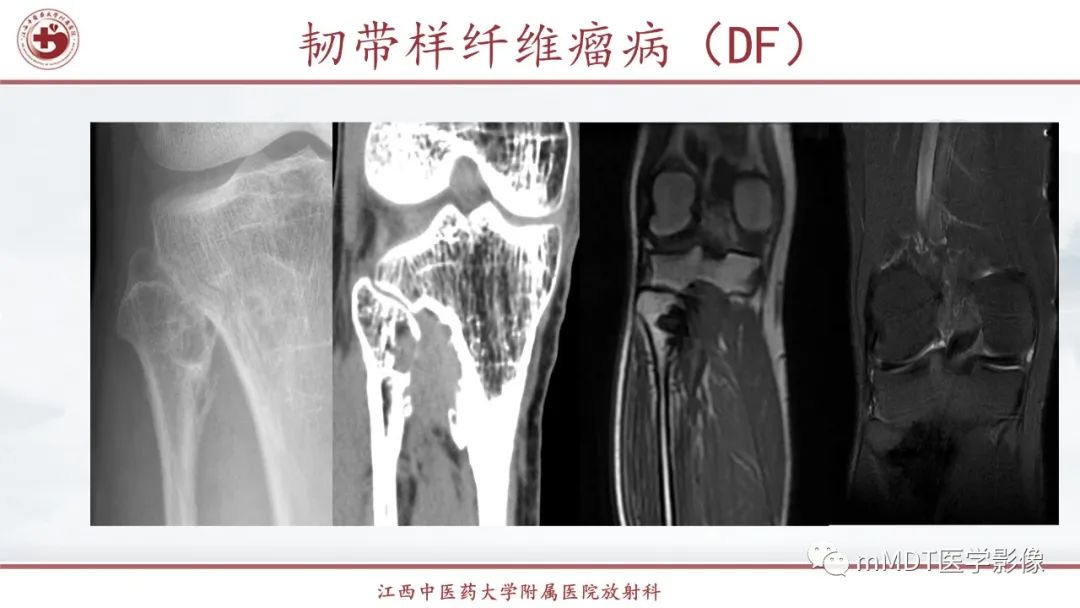影像PPT - 【PPT】超短T2信号为主的局限性骨肌病变-37