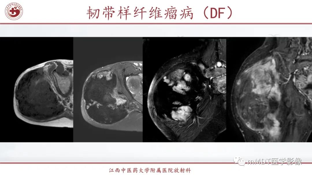 影像PPT - 【PPT】超短T2信号为主的局限性骨肌病变-38