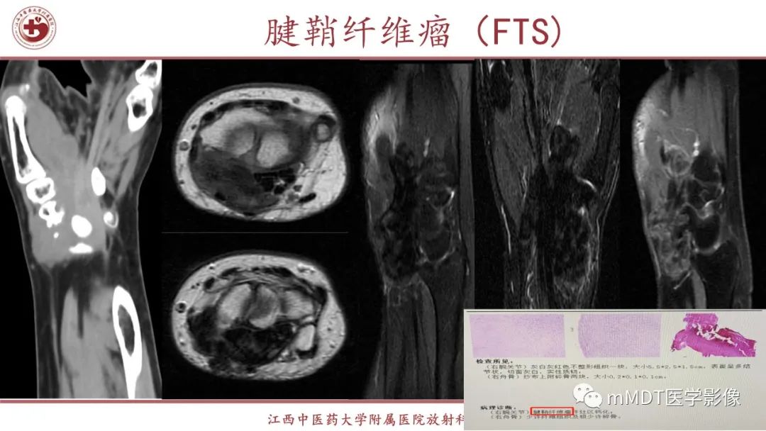 影像PPT - 【PPT】超短T2信号为主的局限性骨肌病变-39