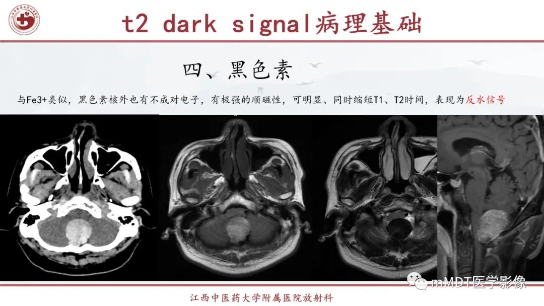 影像PPT - 【PPT】超短T2信号为主的局限性骨肌病变-40