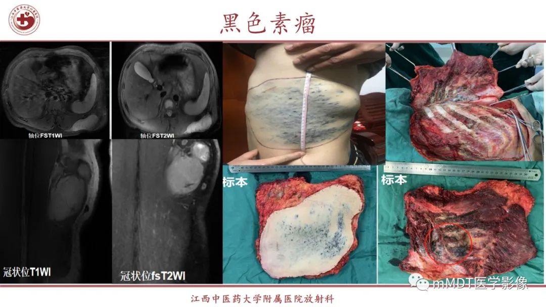 影像PPT - 【PPT】超短T2信号为主的局限性骨肌病变-41