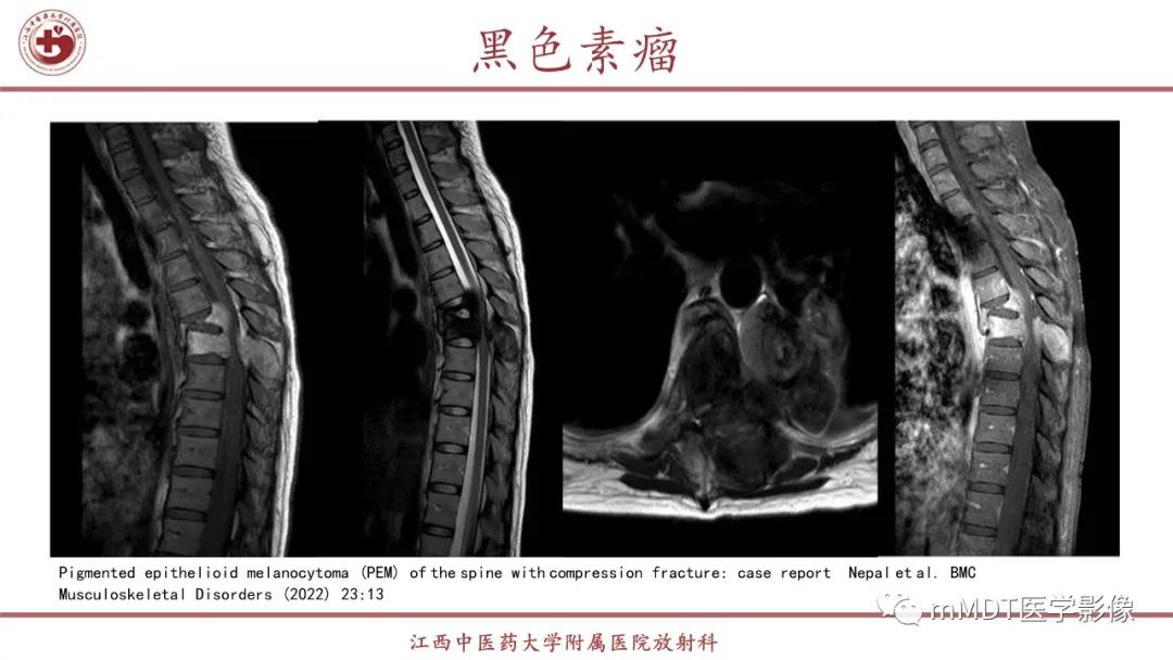 影像PPT - 【PPT】超短T2信号为主的局限性骨肌病变-42