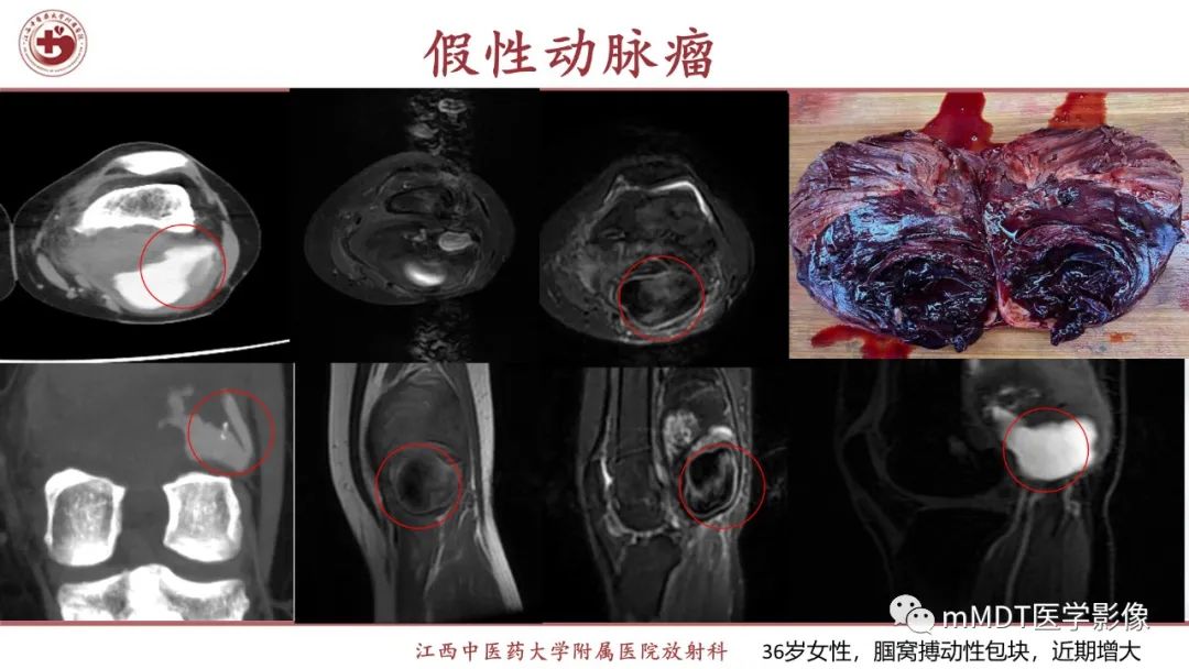影像PPT - 【PPT】超短T2信号为主的局限性骨肌病变-44