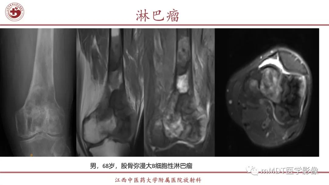 影像PPT - 【PPT】超短T2信号为主的局限性骨肌病变-46
