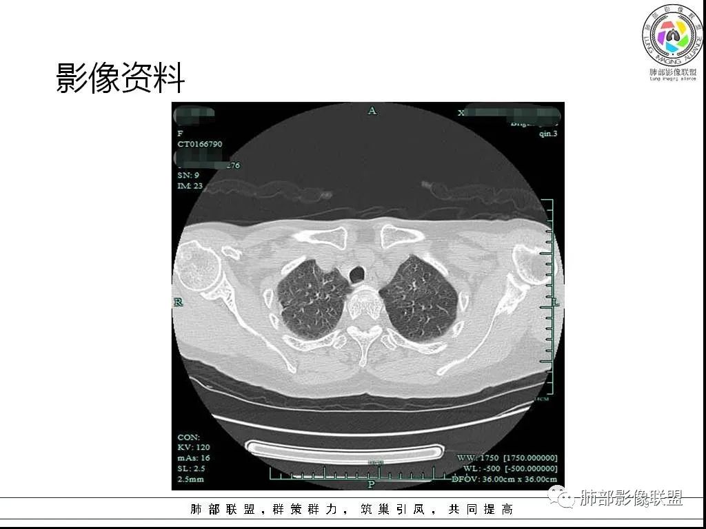 影像PPT - 【病例】鹦鹉热与军团之纠结-9 影像PPT - 【病例】鹦鹉热与军团之纠结-9