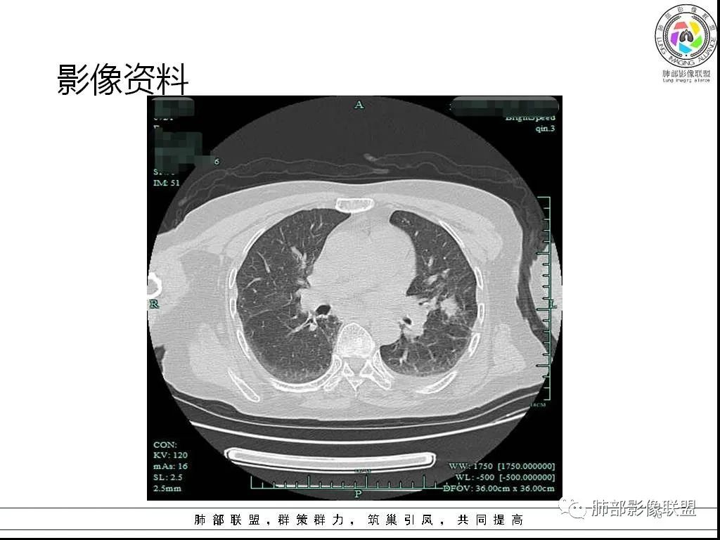 影像PPT - 【病例】鹦鹉热与军团之纠结-10 影像PPT - 【病例】鹦鹉热与军团之纠结-10