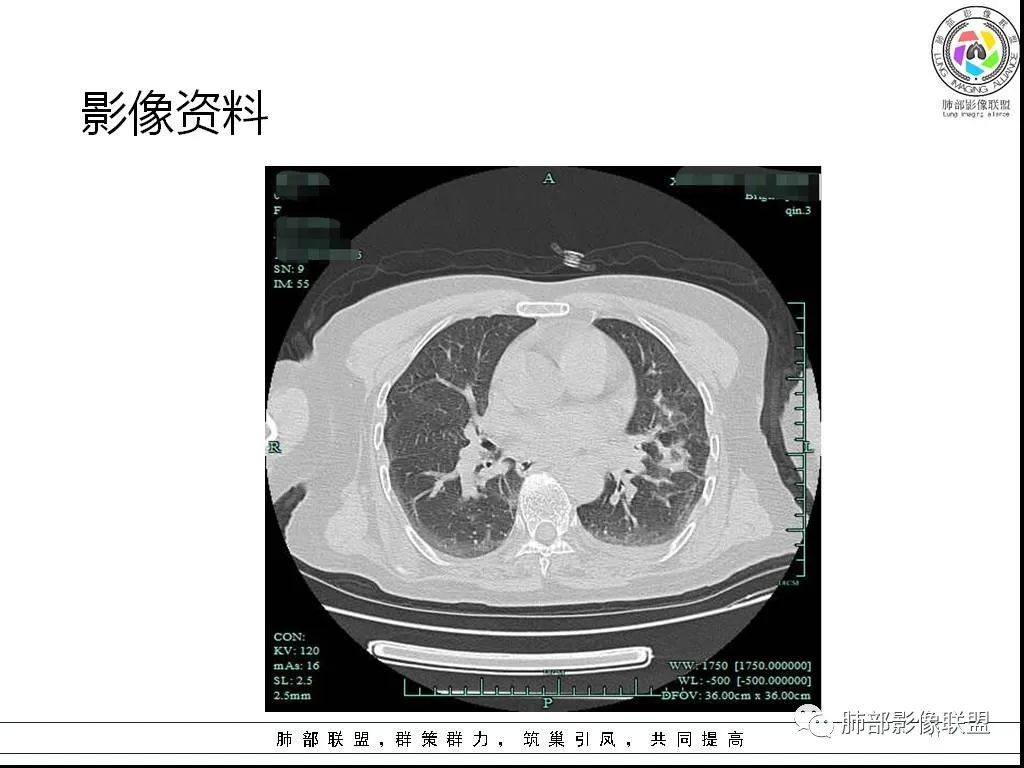 影像PPT - 【病例】鹦鹉热与军团之纠结-11 影像PPT - 【病例】鹦鹉热与军团之纠结-11