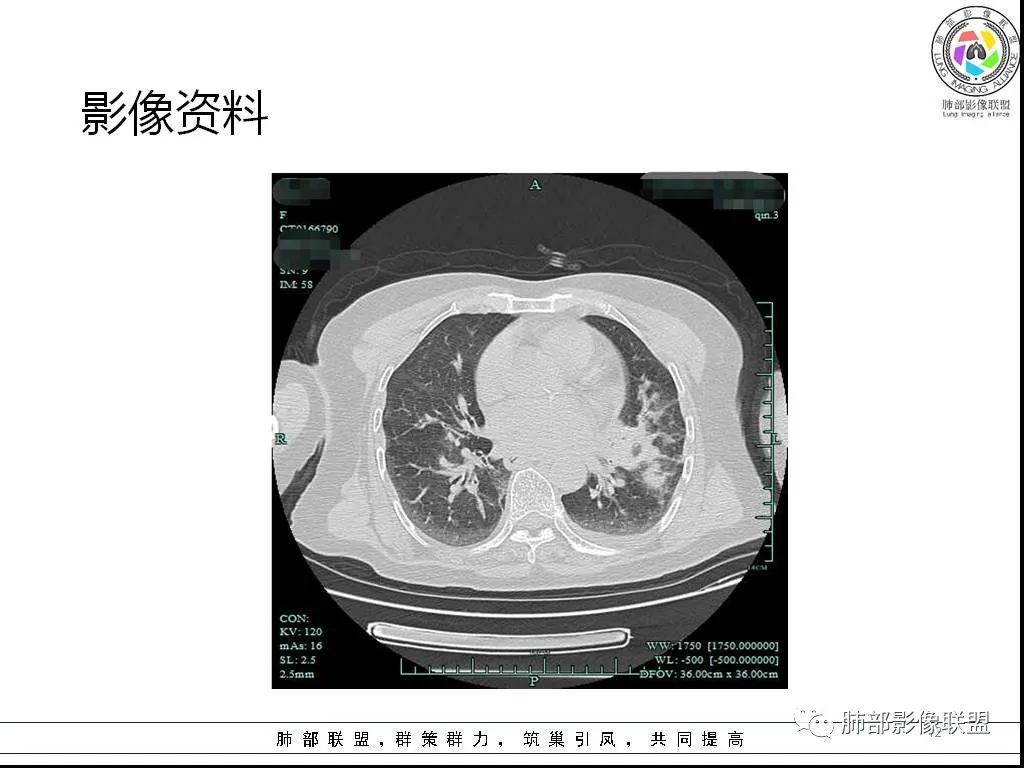 影像PPT - 【病例】鹦鹉热与军团之纠结-12 影像PPT - 【病例】鹦鹉热与军团之纠结-12