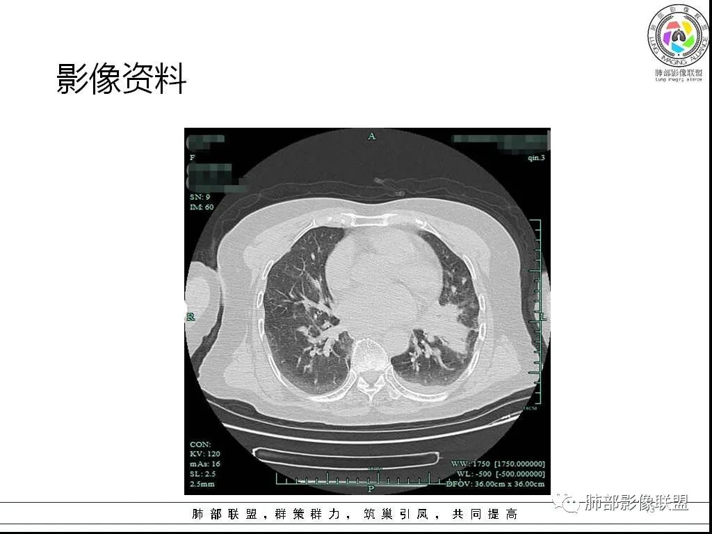 影像PPT - 【病例】鹦鹉热与军团之纠结-13 影像PPT - 【病例】鹦鹉热与军团之纠结-13