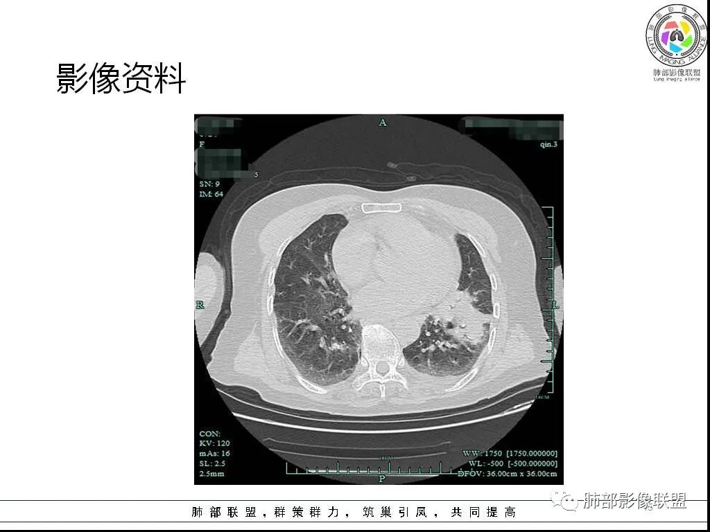 影像PPT - 【病例】鹦鹉热与军团之纠结-15 影像PPT - 【病例】鹦鹉热与军团之纠结-15