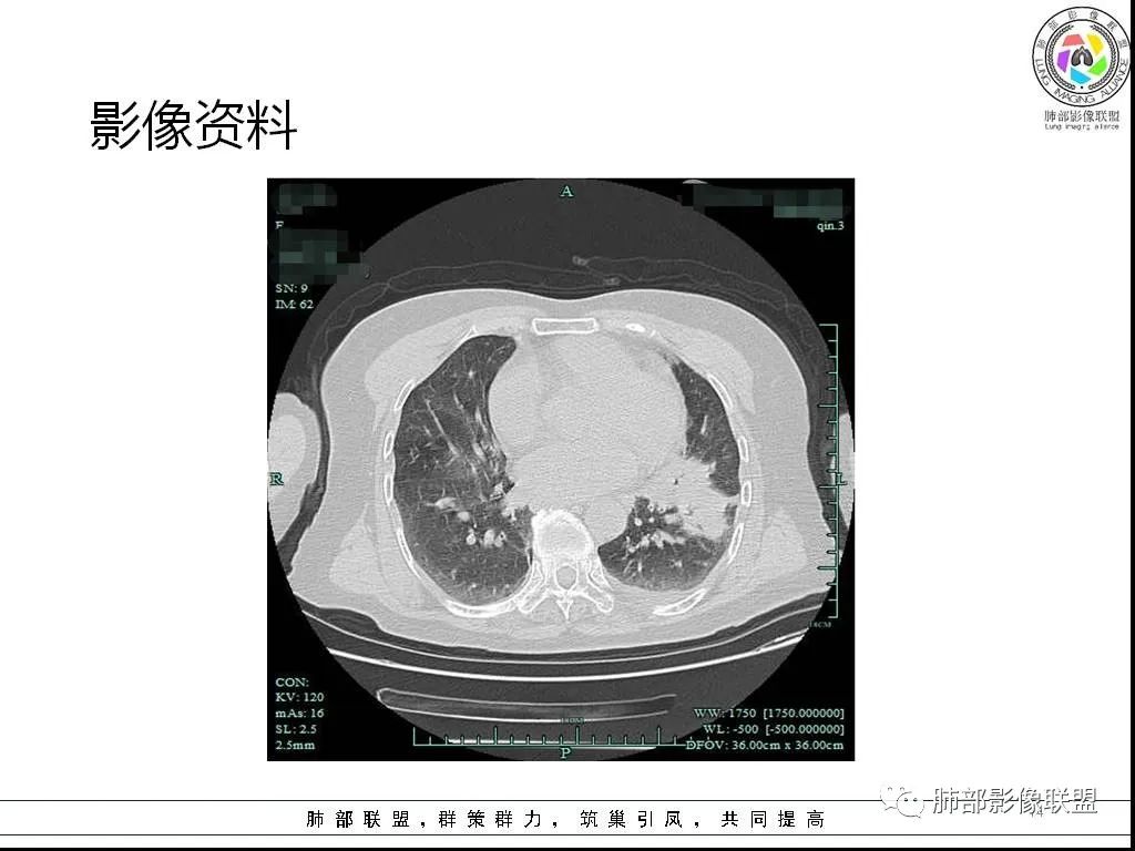 影像PPT - 【病例】鹦鹉热与军团之纠结-14 影像PPT - 【病例】鹦鹉热与军团之纠结-14
