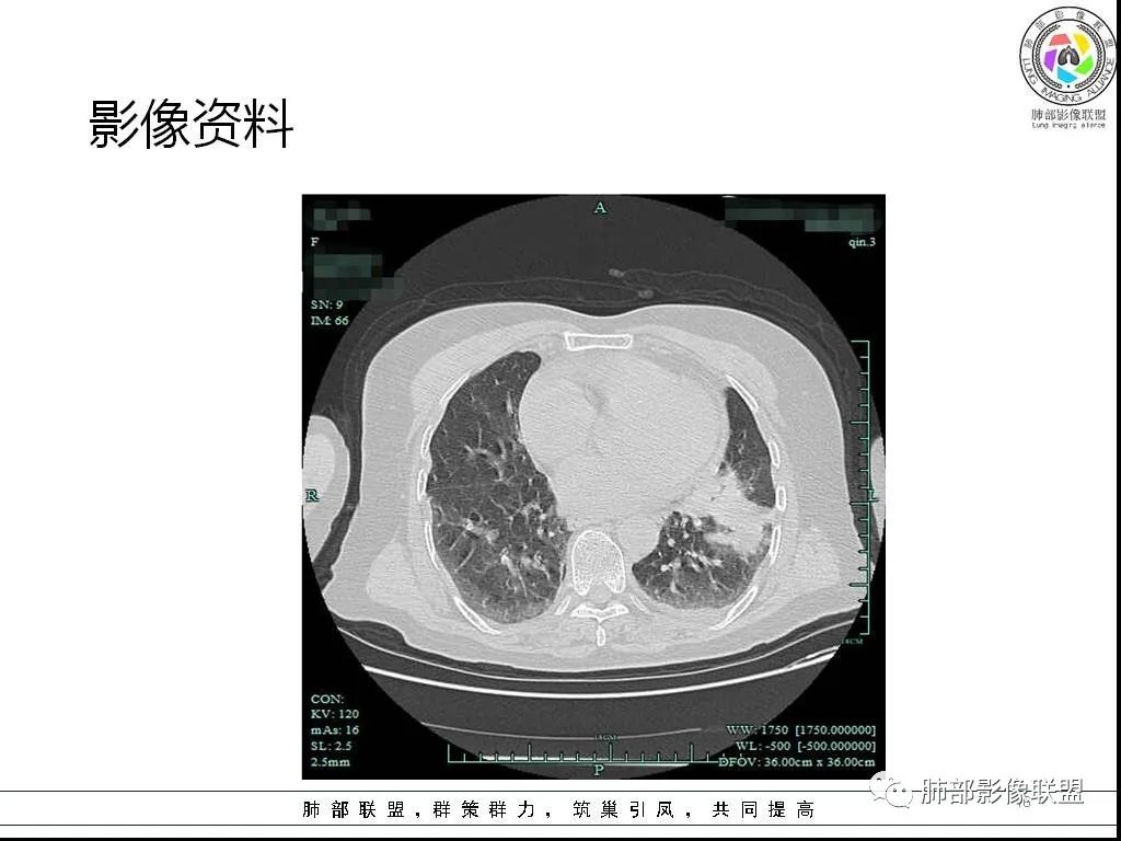 影像PPT - 【病例】鹦鹉热与军团之纠结-16 影像PPT - 【病例】鹦鹉热与军团之纠结-16