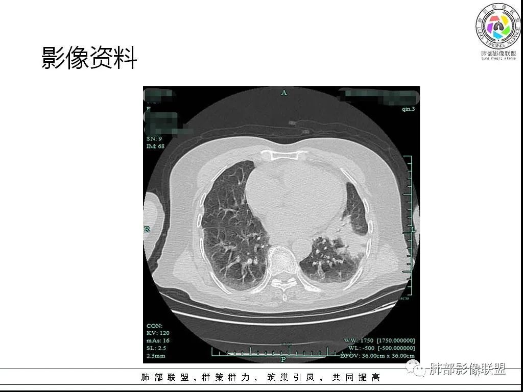 影像PPT - 【病例】鹦鹉热与军团之纠结-17 影像PPT - 【病例】鹦鹉热与军团之纠结-17