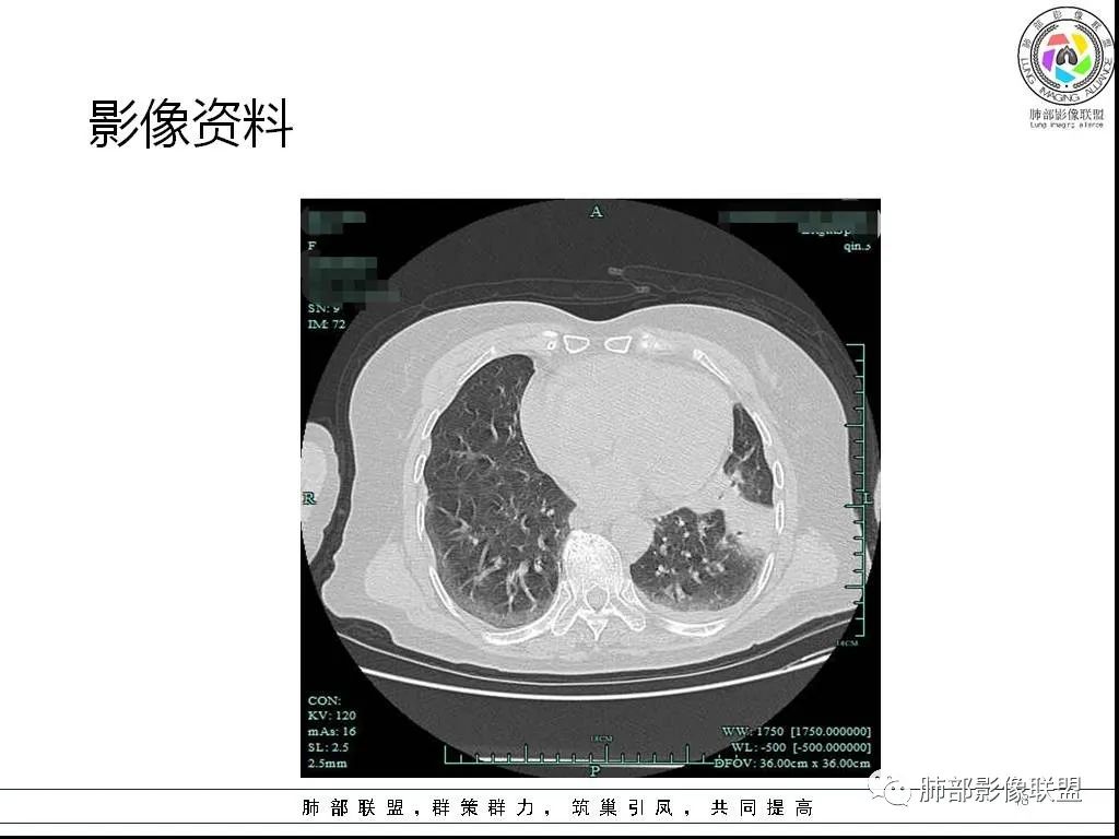 影像PPT - 【病例】鹦鹉热与军团之纠结-18 影像PPT - 【病例】鹦鹉热与军团之纠结-18
