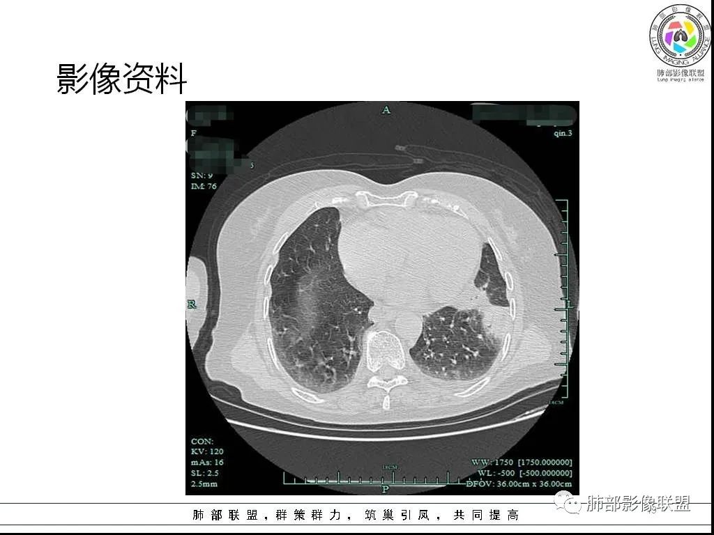 影像PPT - 【病例】鹦鹉热与军团之纠结-19 影像PPT - 【病例】鹦鹉热与军团之纠结-19