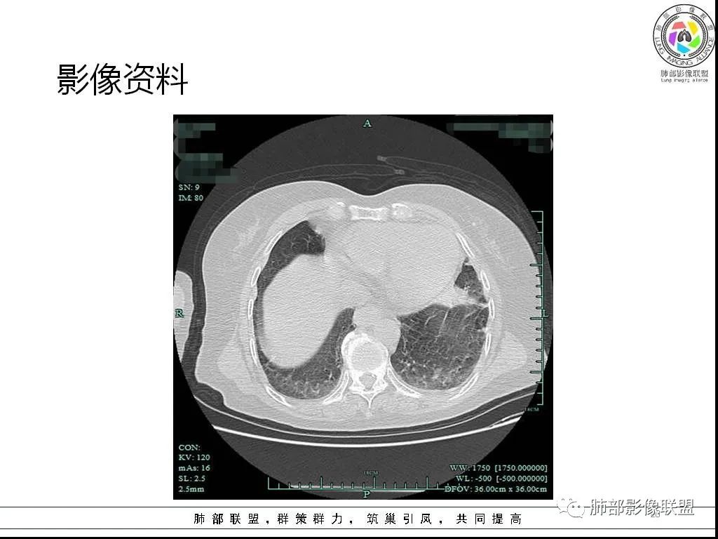 影像PPT - 【病例】鹦鹉热与军团之纠结-20 影像PPT - 【病例】鹦鹉热与军团之纠结-20