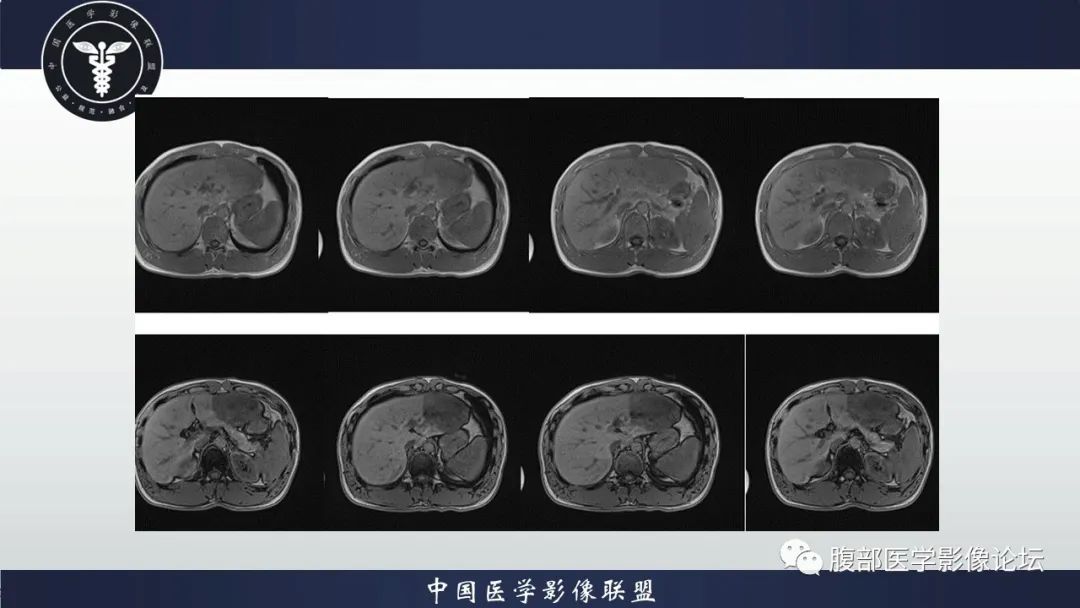 影像PPT - 【病例】肝脏肝细胞腺瘤1例MR影像-5