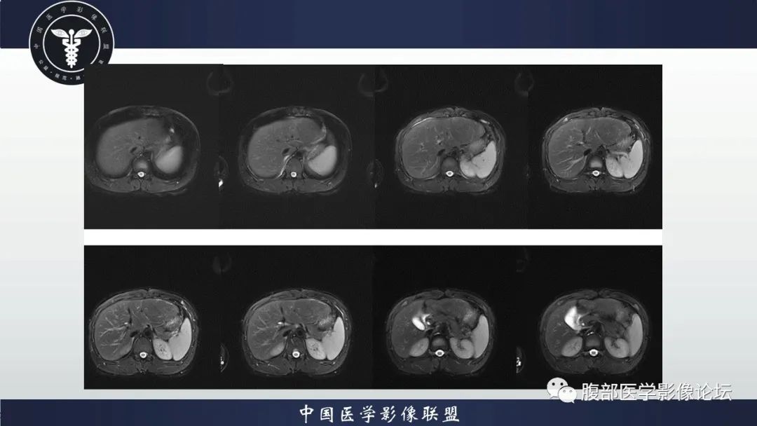 影像PPT - 【病例】肝脏肝细胞腺瘤1例MR影像-4