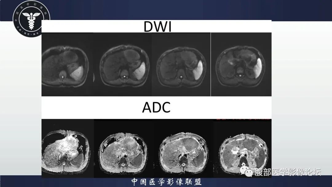 影像PPT - 【病例】肝脏肝细胞腺瘤1例MR影像-6